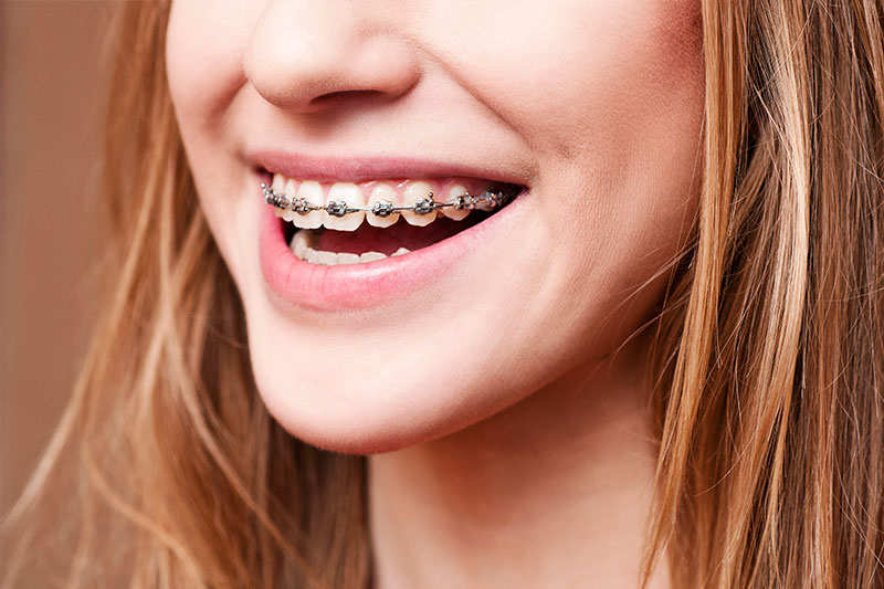 Orthodontics in Summerville