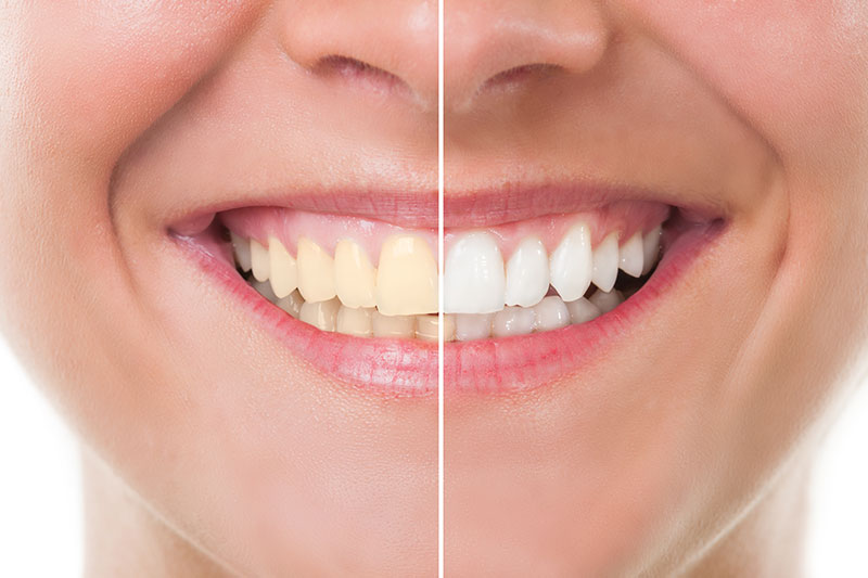 Teeth Whitening in Summerville